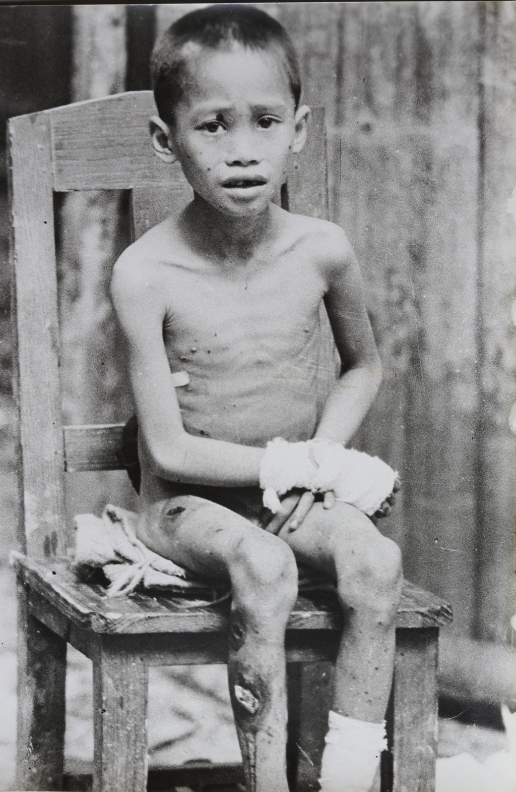 ເດັກນ້ອຍໄດ້ຮັບບາດເຈັບຈາກລະເບີດ